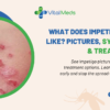 What Does Impetigo Look Like? Pictures, Symptoms & Treatments